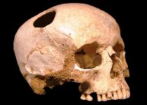 Researchers discover evidence of 7,000-year-old head surgery
