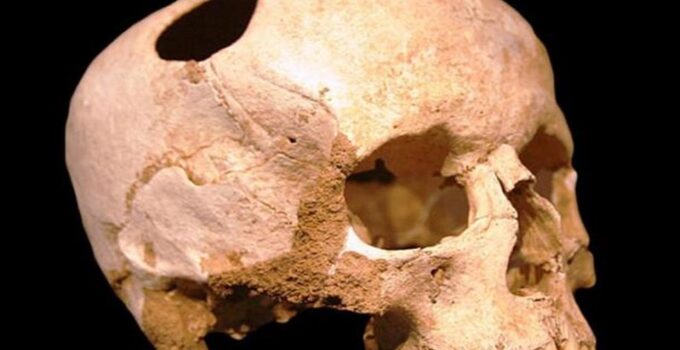 Researchers discover evidence of 7,000-year-old head surgery