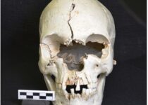 Skull Found On Caribbean Island Shows Evidence Of Leprosy
