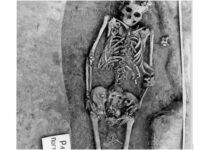 A 7,700-Year-Old Case of Death During Childbirth in Siberia