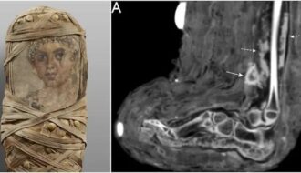 Scan of Child Mummy Reveals Bandages and Pus-Filled Wound