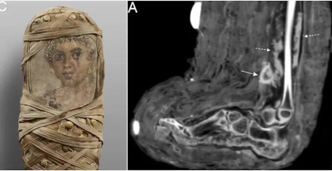 Scan of Child Mummy Reveals Bandages and Pus-Filled Wound