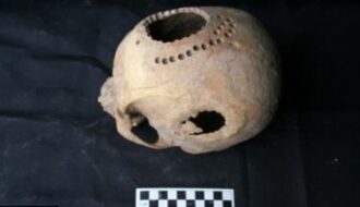 1,000 Years Ago, Patients Survived Brain Surgery, But They Had To Live With Huge Holes in Their Heads